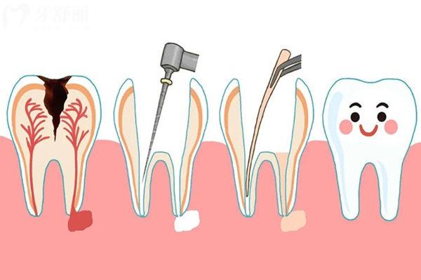 馬鞍山口腔醫(yī)院根管治療收費價格表