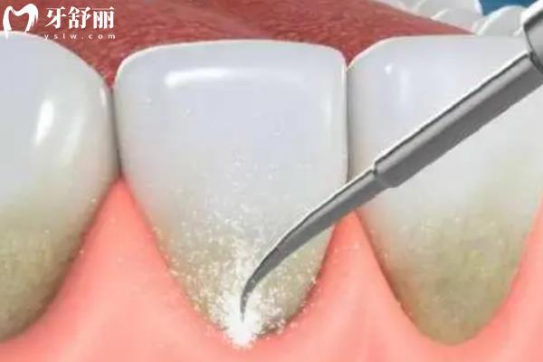 杭州洗牙哪里便宜質(zhì)量還好