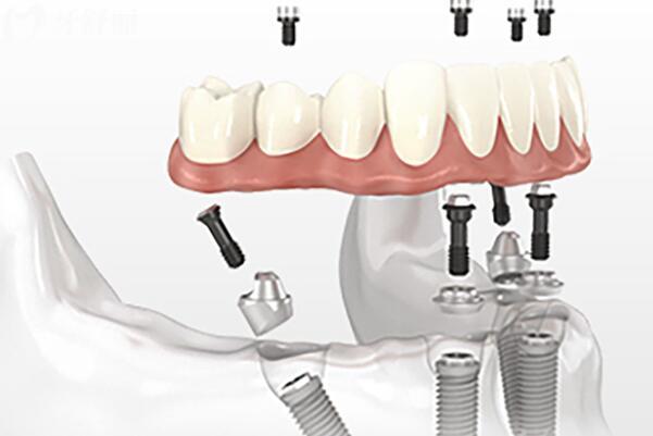 一鍵獲?。∈┒骺谇?026收費(fèi)價(jià)目表:種植牙