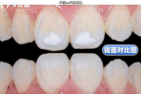 牙齒白斑脫礦治療前后對比圖