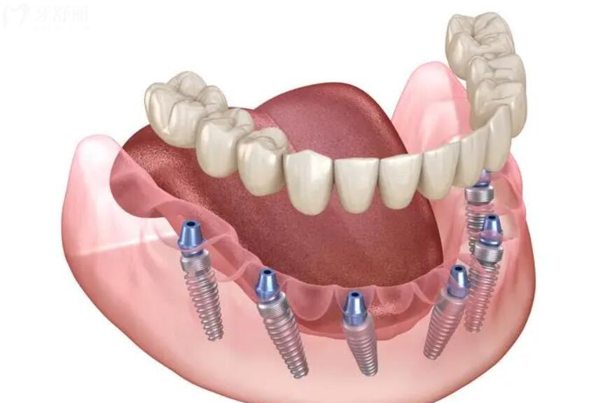 除2026蘭州諾貝爾口腔醫(yī)院補牙價格外,種植牙/正畸/拔智齒/根管收費標準都在這里