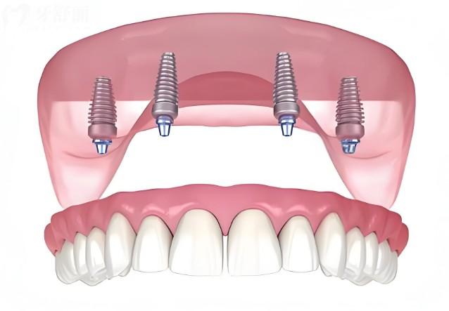 意大利西泰克種植體硬核測(cè)評(píng)！優(yōu)點(diǎn)、質(zhì)量、適用人群、價(jià)格全攻略，看完不踩坑！