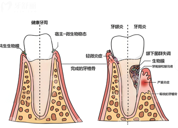 根管治療疼不疼？具體流程為大家介紹下