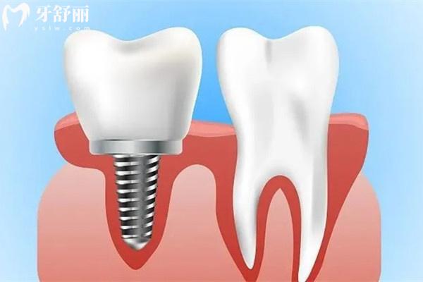 2026諸暨口腔醫(yī)院收費價格表一覽:種植牙矯正補牙價格全透明+避坑指南