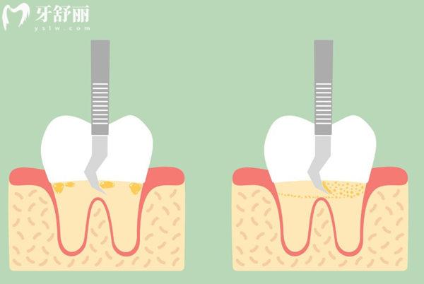 做完牙根管治療注意事項(xiàng)有那些?速存護(hù)牙攻略,輕松避開“二次受罪”的坑