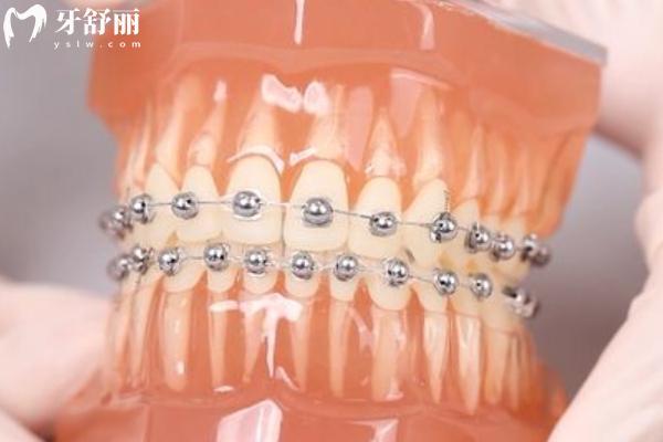 湛江牙齒正畸價格解析