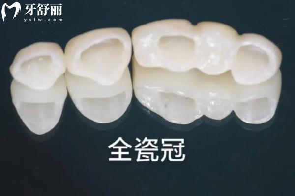 澤武全瓷牙和愛爾創(chuàng)全瓷牙哪個好?細說兩者區(qū)別與選擇要點