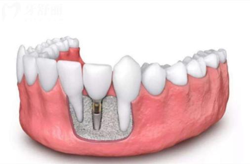 成都裝一顆種植牙多少錢2026價格表:單顆1580~8000起(國產/韓系/歐美)