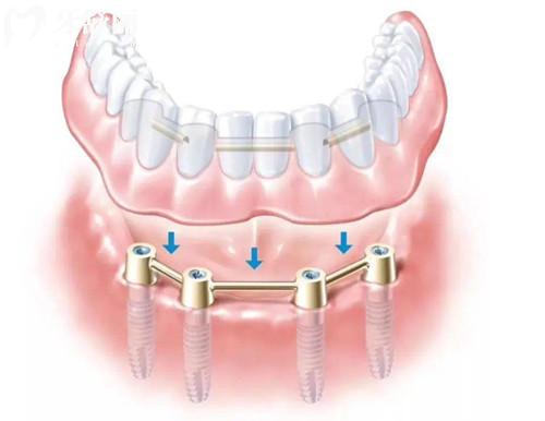 成都裝一顆種植牙多少錢2026價格表:單顆1580~8000起(國產/韓系/歐美)