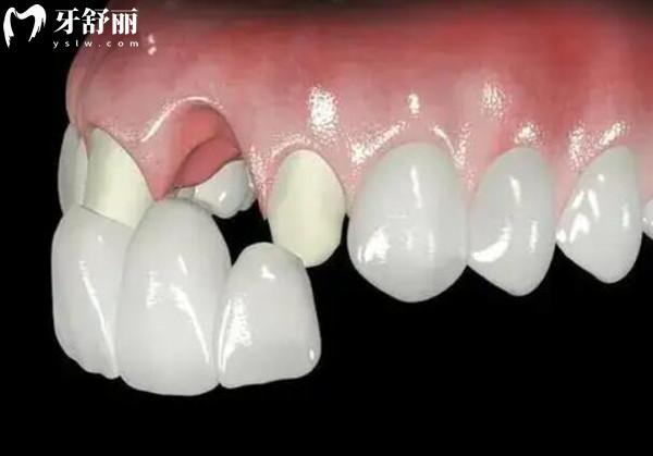 浙愛口腔醫(yī)院收費(fèi)貴嗎2026真實(shí)價(jià)目表來了！種植牙、正畸、根管、美白、拔牙價(jià)格全曝光