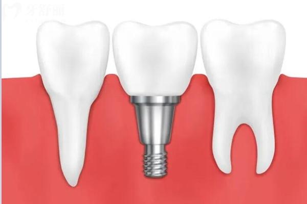 小診所種牙靠譜嗎？怎么判斷口腔機構是否正規(guī)？教你3招識破正規(guī)口腔機構