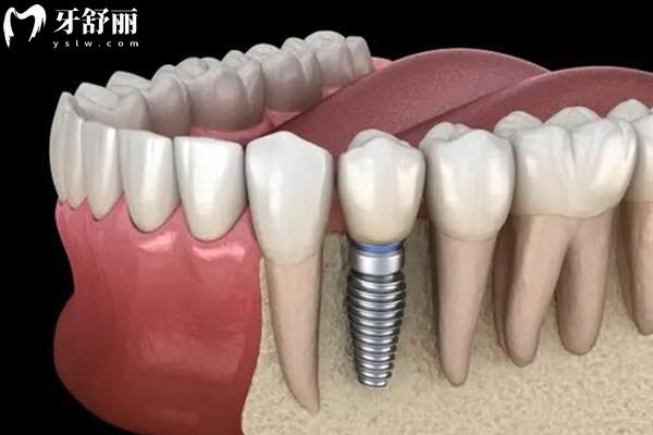 清遠粵美口腔2026收費價目表：種植牙/正畸/全瓷牙冠/根管等項目,算算要花多少錢