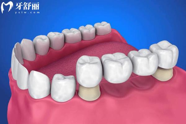 清遠粵美口腔2026收費價目表：種植牙/正畸/全瓷牙冠/根管等項目,算算要花多少錢