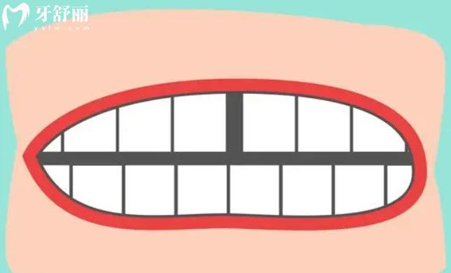 樹脂貼面和瓷貼面有什么區(qū)別？分析優(yōu)缺點看哪個好