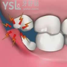 拔掉智齒有什么危害！