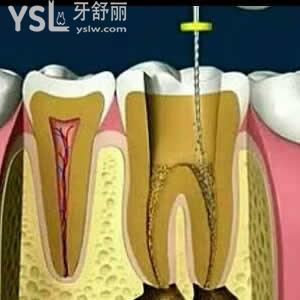 做根管治療到底疼不疼，我從來還沒有做過！