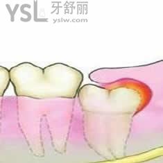 廈門登特口腔拔智齒多少錢？