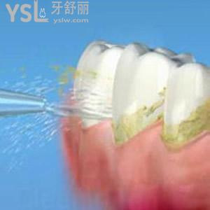 廈門登特口腔超聲波洗牙多少錢？