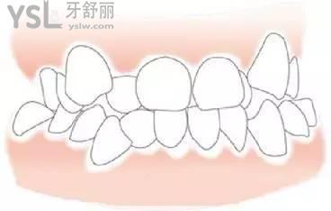 多生牙是怎么回事一定要拔嗎？拔完還需要做矯正嗎？
