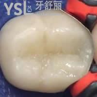 天津愛(ài)齒口腔樹(shù)脂補(bǔ)牙雙11優(yōu)惠價(jià)格