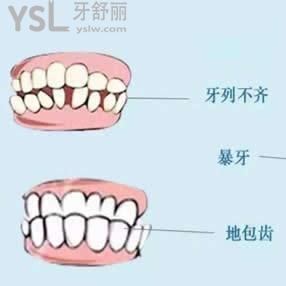 廣州雅度口腔正雅隱形矯正雙11優(yōu)惠價(jià)格活動(dòng)