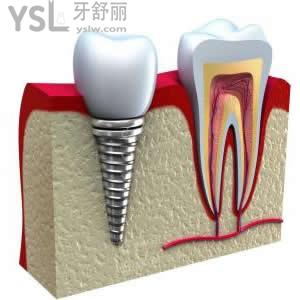 發(fā)布北京瑞冠口腔韓國奧齒泰種植體價格