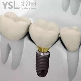 長春超龍牙博士口腔韓國進口種植牙價格大優(yōu)惠了