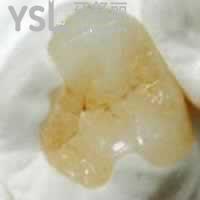 補牙是根據(jù)牙洞大小收費的嗎？補牙的材料應該怎么選？