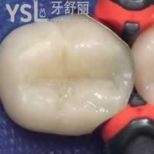 當(dāng)雙十二遇上廣州圣貝口腔8周年慶-進口樹脂補牙只需138元起