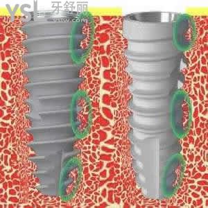 成都圣貝牙科韓國(guó)NEO紐百特種植體+金屬烤瓷冠價(jià)格