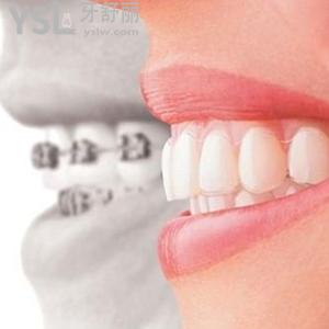 鄭州唯美口腔牙齒矯正多少錢(qián)