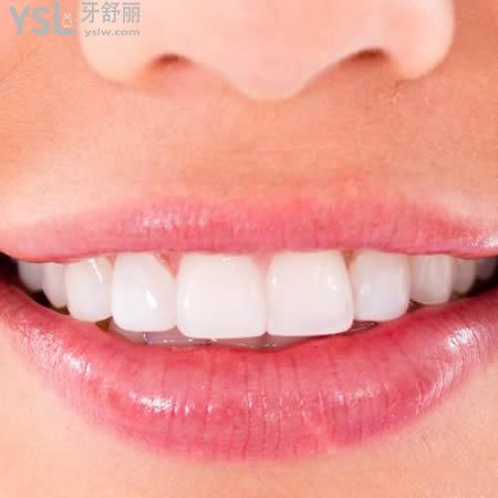 昆明雅度口腔美加超薄瓷貼面收費(fèi)標(biāo)準(zhǔn)