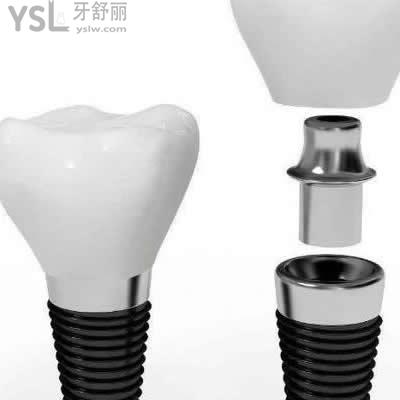 深圳格倫菲爾口腔美國3i種植牙收費(fèi)價(jià)格