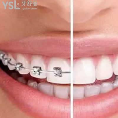 深圳格倫菲爾口腔傳統(tǒng)金屬托槽牙齒矯正價(jià)格貴嗎？