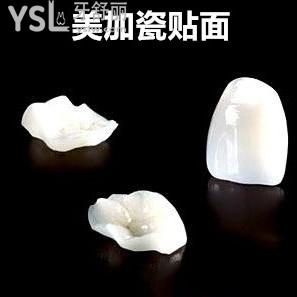 南寧柏樂口腔美加瓷貼面收費(fèi)價(jià)格怎么樣？