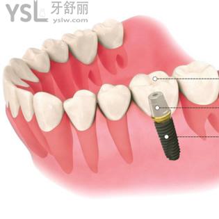深圳正夫口腔法國安卓?。ˋnthogyr）種植牙價格表