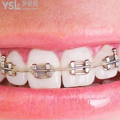 深圳正夫口腔金屬托槽牙齒矯正費用