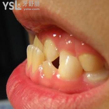 深圳正夫口腔成人地包天牙齒矯正價格