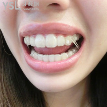 深圳雷蕾口腔隱適美（invisalign）矯正價格會不會很貴呢？