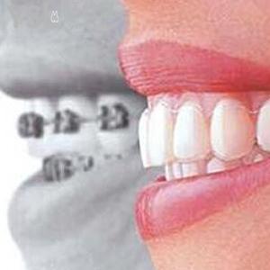 深圳拜爾口腔牙齒矯正收費標(biāo)準(zhǔn)