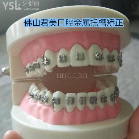 佛山春芽口腔怎么樣？國產(chǎn)金屬托槽矯正價格來襲