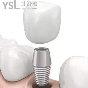 深圳拜爾口腔韓國登騰種植牙價(jià)格表