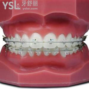 深圳世紀(jì)河山口腔隱形托槽牙齒矯正價(jià)格