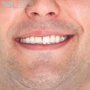 揭秘長安金典口腔韓國登騰種植牙價格表及顧客評價