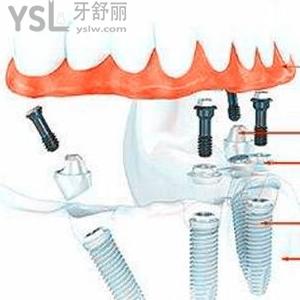 西安中諾口腔醫(yī)院半口種植牙價(jià)格