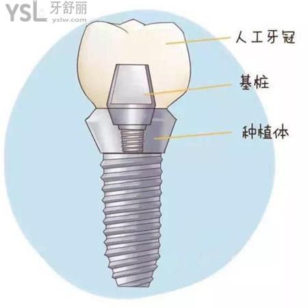 新公布廣州瑞德口腔進口種植牙價格表