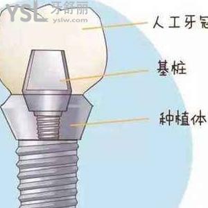 鄭州唯美口腔種植牙多少錢(qián)一顆