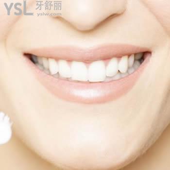 提供一份廣州雅度口腔進口3m  p60樹脂補牙價格表及顧客評價