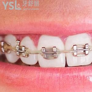 廣州廣大口腔金屬自鎖托槽牙齒矯正收費(fèi)怎么樣