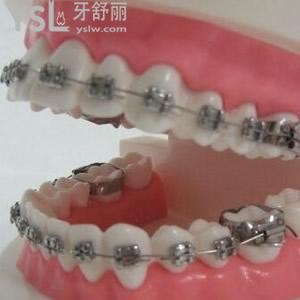 重慶口碑比較好的齊美口腔傳統(tǒng)金屬牙齒矯正價格活動來嘍！